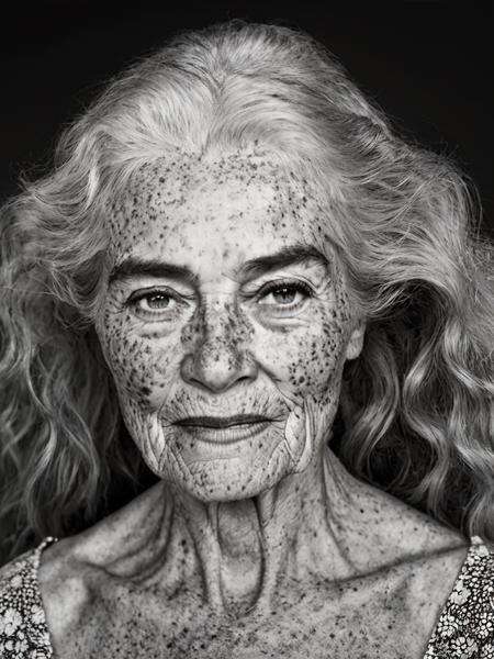 Freckles